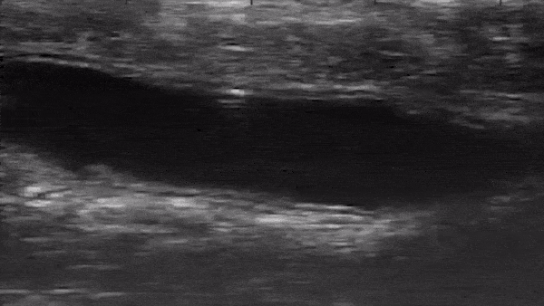 쥐의 대장 속에서 이동하는 마이크로 로봇의 모습.