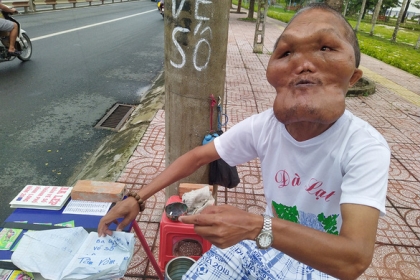 [여기는 베트남] 얼굴은 기형이지만 마음은 ‘천사’…고엽제 피해자의 삶 