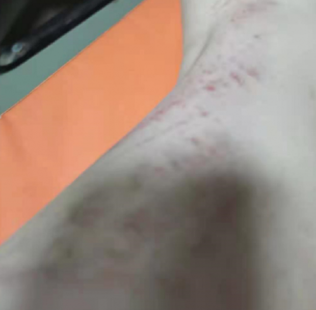 교장 진씨의 폭행으로 정 씨 몸에 남은 상처