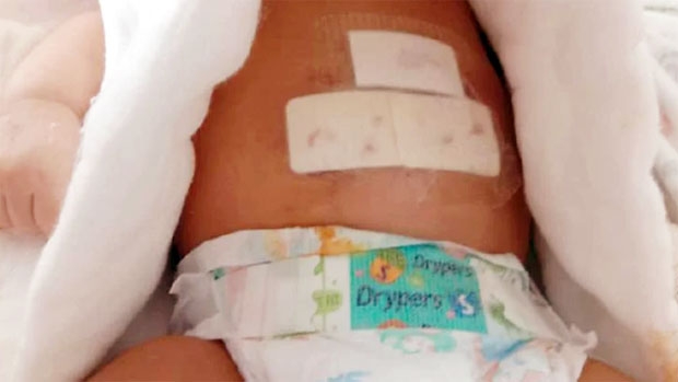 머리와 얼굴, 배를 심하게 물린 아기는 수술을 받고 현재 병원에서 회복 중이다. 의료진은 장기가 보일만큼 복부 상처가 특히 심했다고 밝혔다. 아기는 앞으로 2주 더 병원에서 입원 치료를 받아야 하는 상태다.