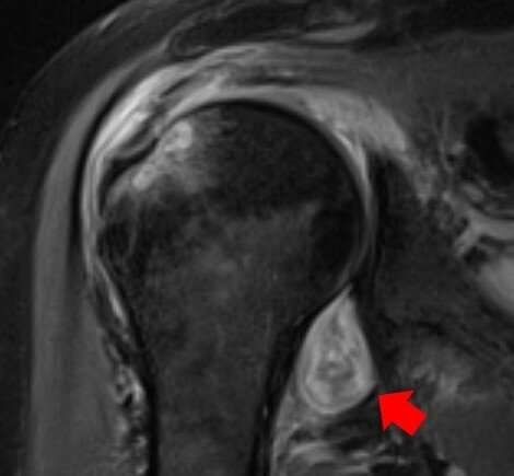 어깨 부위에 세포 염증이 발생한 코로나19 환자의 MRI. 노스웨스턴대학 제공 어깨 부위에 세포 염증이 발생한 코로나19 환자의 MRI. 노스웨스턴대학 제공