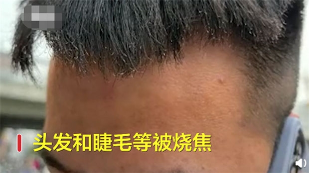 첸씨는 머리카락과 속눈썹이 그을렸으며 팔에 경미한 화상을 입었다. 첸씨의 여자친구는 “원래 남자친구 속눈썹이 굉장히 길었는데, 불에 타는 바람에 얼굴이 못쓰게 됐다”고 속상함을 드러냈다.