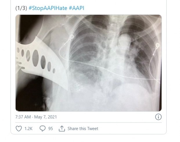 각각 85세, 60대로 알려진 아시아계 여성 2명은 4일 오후 5시 경, 샌프란시스코 시내 중심가의 버스 정류장에 앉아 버스를 기다리다가 50대 남성으로부터 흉기 공격을 받아 크게 다쳤다. 피해 여성 중 한 명의 팔에 용의자의 칼이 박혀 있는 X-레이 사진