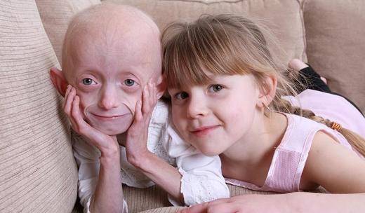 선천성 조로증을 앓다 18세 생일이 지난 후 결국 세상을 떠난 영국의 아샨티 스미스. 10년 전 8살 무렵의 모습.