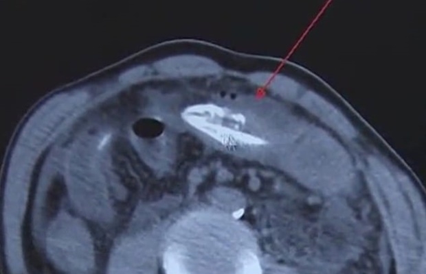 지난해 6월 광둥성의 한 남성도 40㎝ 길이 거대 장어(사진)를 배 속에 넣었다가 죽을 고비를 넘겼다.