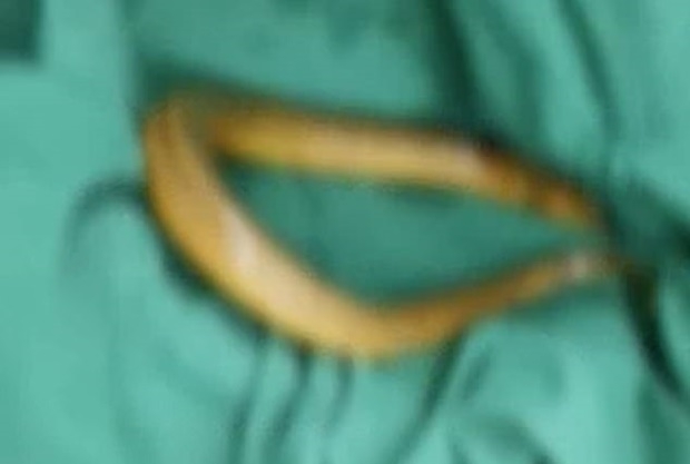 수술 당시 장어는 이미 죽어 있었으나, 환자는 세균 감염이 심각한 상태였다. 위장 등 복부에는 오염물질이 가득 차 있었으며, 대장에는 장어가 움직이고 깨물면서 생긴 구멍도 나 있었다.