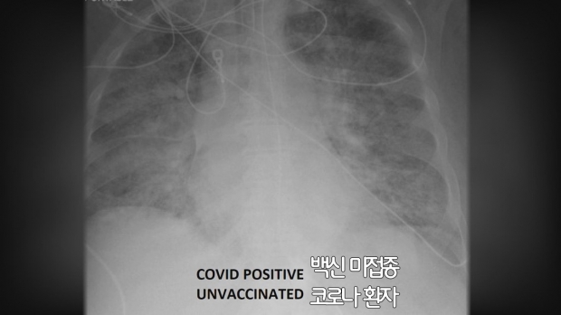 백신을 맞지 않은 상태에서 코로나19에 감염된 환자의 폐 X레이 사진