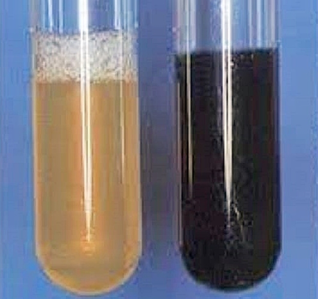 정체불명의 어패독으로 인한 하프병은 근육통과 메스꺼움은 물론, 콜라색 검은 소변을 보는 횡문근융해증을 동반한다.
