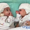 머리 붙은 채 태어난 샴쌍둥이, 분리 후 처음 마주 본 순간 (영상)