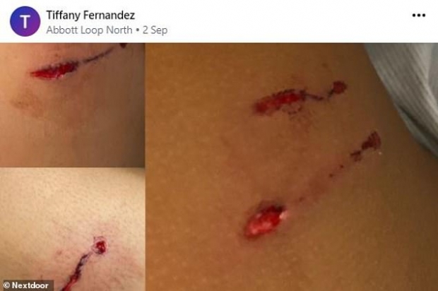 에이든이라는 이름의 9세 소년이 수달 무리에게 습격당해 몸에 상긴 상처들.(사진=티파니 페르난데스/넥스트도어)