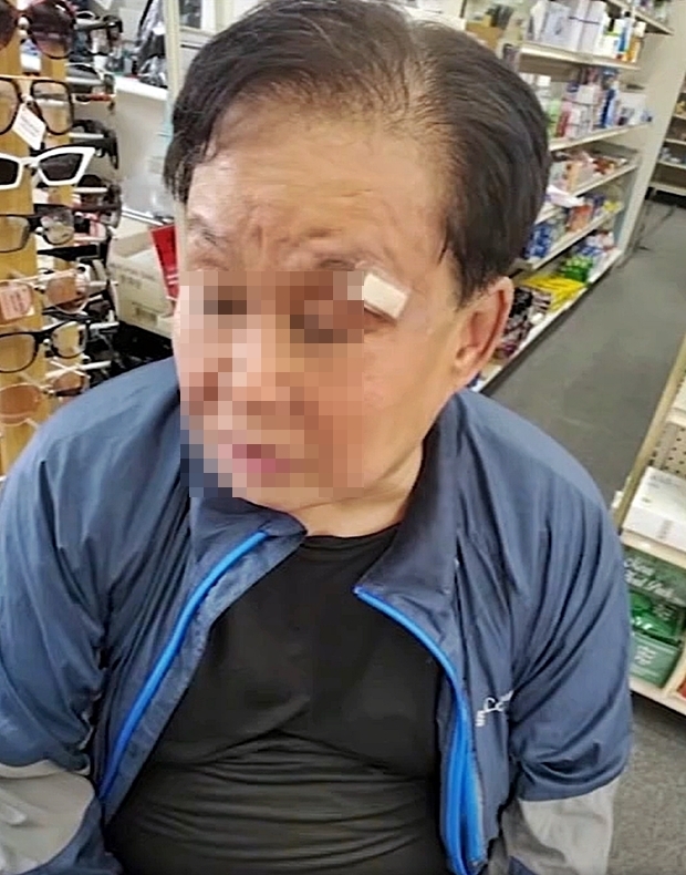 강 회장은 “버스를 기다리는데 지나가던 흑인이 가던 길을 멈추고 돌아서서 내게 욕설을 퍼붓기 시작했다. ‘너희 나라로 돌아가라’고 여러 차례 소리쳤다. 그냥 꾹 참고 있었는데 더 가까이 다가오더니 얼굴을 정면으로 가격했다”고 밝혔다. 이어 “안경을 쓰고 있던 나는 무방비 상태로 폭행을 당했고, 깨진 안경 렌즈 파편에 왼쪽 눈썹 부위가 찢어졌다”고 설명했다.