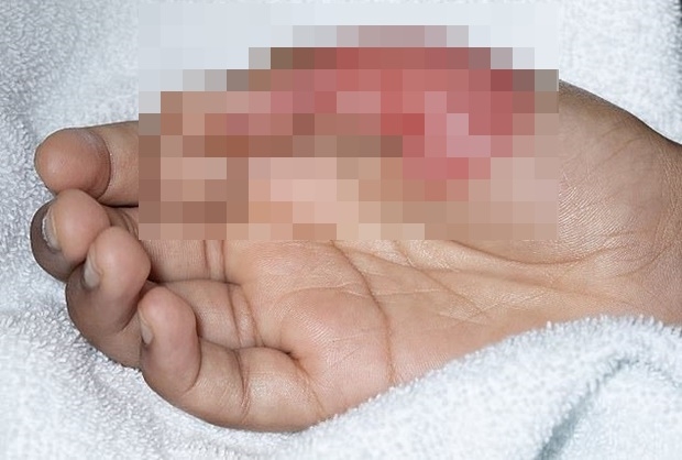 영국도 비슷한 상황이다. 지난달 20일 영국화상협회(BBA)는 “오징어게임 달고나 유행에 따라 어린이 화상 환자가 속출하고 있다”면서 대부분 수술이 필요할 정도로 부상이 심각한 상태라고 주의를 당부했다.