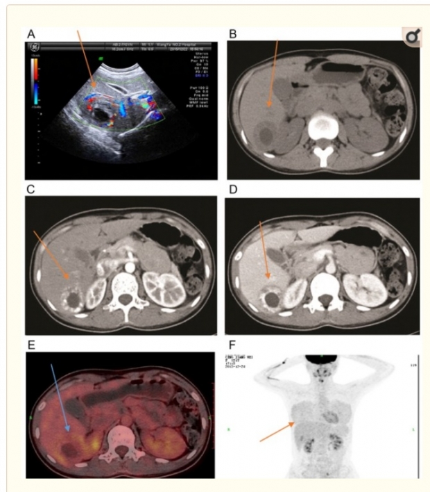 2017년 미국 국립도서관 건강의학연구소가 공개한 간 자궁 외 임신 여성의 사례. 자궁 외임신 환자의 간 영상 결과 (A) 초음파 영상 (B) CT 일반 스캔. 주황 색 화살표는 자궁 외 임신으로 확인된 수정란의 위치.