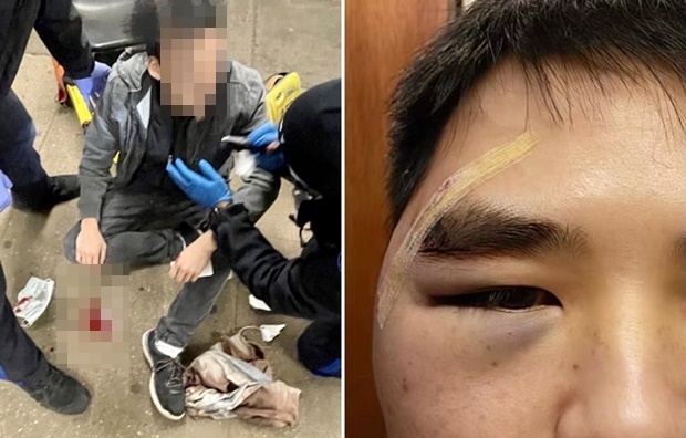 뉴욕에서는 9일에도 아시아계를 겨냥한 ‘망치 폭행’ 사건이 발생했다. 29세 아시아계 남성은 이날 밤 9시쯤 맨해튼 한 지하철역에서 처음 본 ‘여장 남자’에게 폭행을 당했다. 가해자는 가방에서 꺼낸 망치로 남성의 머리를 강타했다.