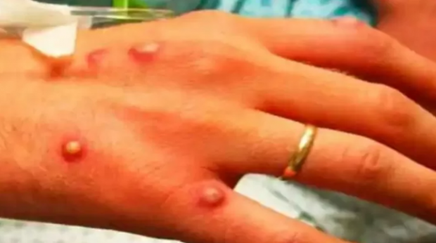 원숭이두창 감염자의 피부 증상 자료사진