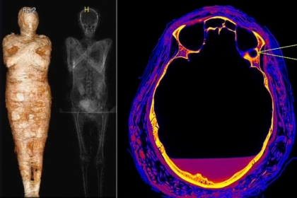 [핵잼 사이언스] “세계 유일 ‘2000년 전 임신한 미라’ 사인은 비인두암”