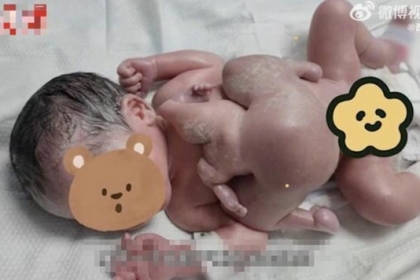 ‘기생 쌍둥이’ 달고 태어난 아기…목숨 건 분리 수술 성공 [여기는 중국]