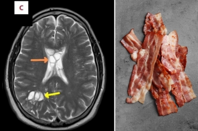 덜 익은 베이컨→기생충 침투→뇌에 알 낳아…두통 원인 충격[포착]