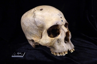 4000년 전 두개골에 ‘암 수술’ 흔적이…고대 이집트서 외과 치료 [핵잼 사이언스]