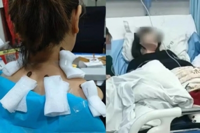 거머리로 목 디스크 흡혈 치료?…‘세균 감염’된 中 여성 [여기는 중국]