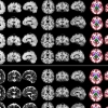 방사선 노출 없어···‘포터블 MRI’로 알츠하이머 진단 개선되나