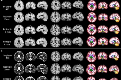 방사선 노출 없어···‘포터블 MRI’로 알츠하이머 진단 개선되나