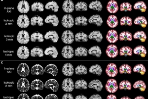 방사선 노출 없어···‘포터블 MRI’로 알츠하이머 진단 개