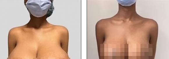 캐나다의 19세 여성은 2022년 9월 화이자 코로나19 백신을 접종한 뒤 가슴이 빠르게 커지는 증상(왼쪽)을 겪었다. 이후 정확한 원인을 찾지 못한 여성은 외과적 수술을 통해 가슴 축소 성형술(오른쪽)을 받아야 했다. PRS글로벌오픈 제공 캐나다의 19세 여성은 2022년 9월 화이자 코로나19 백신을 접종한 뒤 가슴이 빠르게 커지는 증상(왼쪽)을 겪었다. 이후 정확한 원인을 찾지 못한 여성은 외과적 수술을 통해 가슴 축소 성형술(오른쪽)을 받아야 했다. PRS글로벌오픈 제공