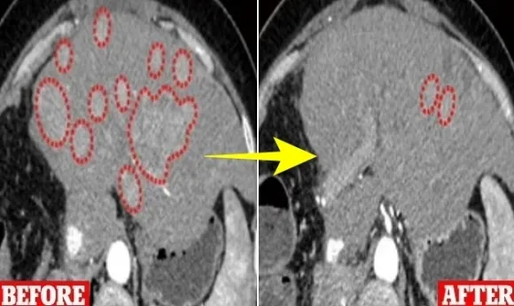 중국 광시의과대학 자오용샹 박사 연구진의 실험 결과. 변형된 뉴캐슬병바이러스를 주입한 간암 환자의 암세포 크기가 달라진 것을 볼 수 있다. 왼쪽은 실험 전, 오른쪽은 실험 후 CT 사진. 셀 저널 캡처