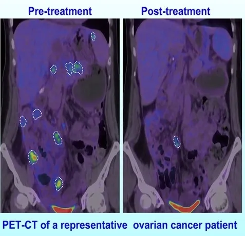 중국 광시의과대학 자오용샹 박사 연구진의 실험 결과. 변형된 뉴캐슬병바이러스를 주입한 난소암 환자의 암세포 크기가 달라진 것을 볼 수 있다. 왼쪽은 실험 전, 오른쪽은 실험 후 CT 사진. 셀 저널 캡처