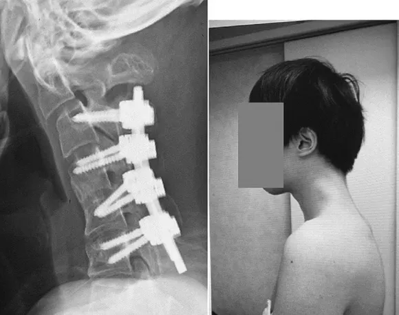 2023년 JOS케이스리포츠에 의료 사례가 공개된 25세 남성. 뼈에 보정물을 넣어 고정시키는 수술을 받고 일상을 회복했다. JOS 케이스리포츠 제공 2023년 JOS케이스리포츠에 의료 사례가 공개된 25세 남성. 뼈에 보정물을 넣어 고정시키는 수술을 받고 일상을 회복했다. JOS 케이스리포츠 제공