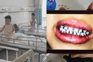 “탈모에 치아 까매져” 중국 유치원생 ‘단체 납중독’ 진단 파문