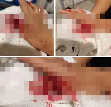 이 사고로 여성은 손가락 힘줄이 끊어지는 중상을 입었다. 페이스북 Pat Patcharaluk 캡처 이 사고로 여성은 손가락 힘줄이 끊어지는 중상을 입었다. 페이스북 Pat Patcharaluk 캡처
