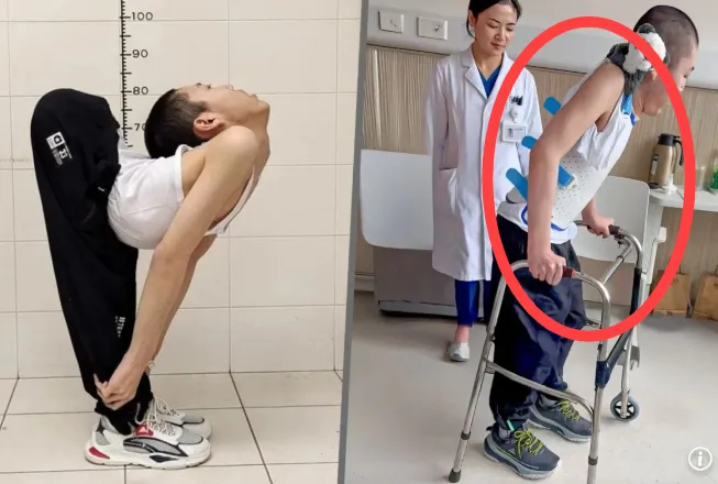 몸이 Z자로 접힌 ‘폴더 소년’ 장옌천(21)이 똑바로 서서 걸음을 내딛는 데 성공했다. SCMP 제공 몸이 Z자로 접힌 ‘폴더 소년’ 장옌천(21)이 똑바로 서서 걸음을 내딛는 데 성공했다. SCMP 제공