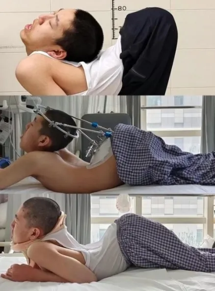 강직 척추염 진단을 받은 뒤 꾸준히 상태가 악화하던 장 씨는 뒤늦게 치료를 시작했다. 강직 척추염 진단을 받은 뒤 꾸준히 상태가 악화하던 장 씨는 뒤늦게 치료를 시작했다.