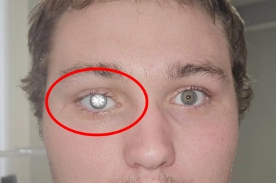 thumbnail - ‘진짜 2캐럿 다이아몬드’ 눈에 심은 남성의 반전 사연 (영상)