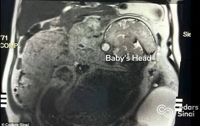 미국 캘리포니아에서 거대한 난소 종양 제거 수술을 앞두고 있던 한 여성이 임신 사실을 알게 된 뒤 며칠 만에 건강한 아기를 출산하는 기적이 일어났다. 사진=시더스-시나이 메디컬센터