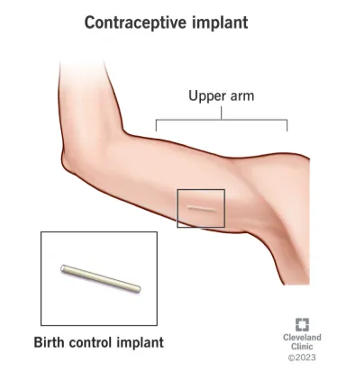 피부에 이식하는 피임 임플란트 예시