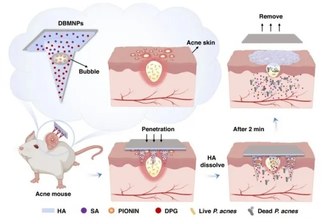 미세침 패치의 작동 방식. 출처: Zhang, X., et al. Microsyst Nanoeng 11