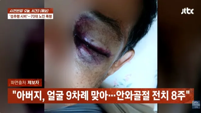 성추행 의심을 받다 폭행당한 70대 남성이 안와골절 등 전치 8주 진단을 받았다고 호소했다. JTBC ‘사건반장’ 방송화면 캡처