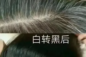 흰머리 검게 해준다더니 삭발 후 족집게? 황당한 1200만원 클리닉 비법